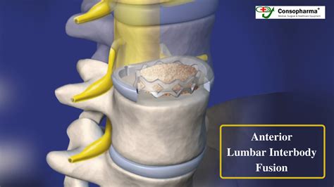 Anterior Lumbar Interbody Fusion - The Best Treatment for Disc Problems ...