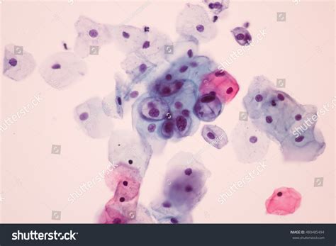 Abnormal Pap Smear Hpv