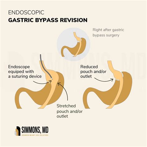 Gastric Bypass Revision