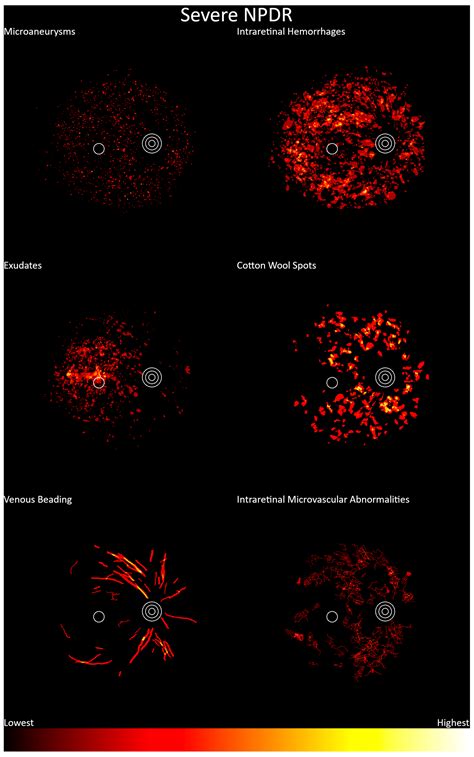 Programmatically Localizing Diabetic Retinopathy Features in 45-Degree ...
