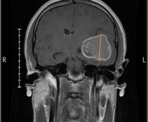 Beating the odds: Glioblastoma patient thriving 6 years after being told he had 6 months to live ...