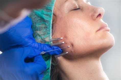 Premium Photo | Mesotherapy facelifting procedure 3d meso threads