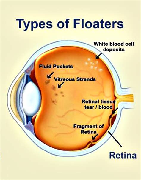 Image result for Eye Floater Types