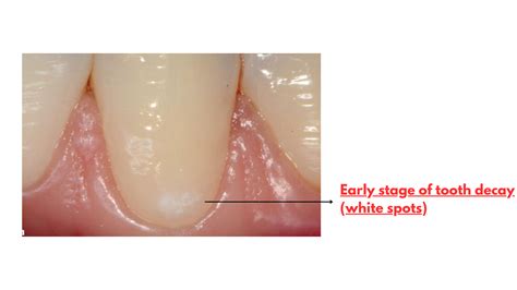 Spot & Stop the Early Stage of Tooth Decay (With Pictures)