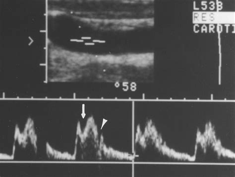 Pulse Doppler Waveform at Melissa Frink blog