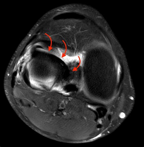 Bucket-handle Tear of the Meniscus - Radsource