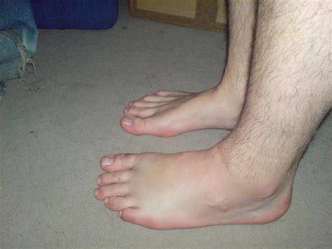 Another View Of My Swollen foot. | Lovely, my foot looks so … | Flickr