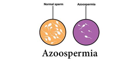 AZOOSPERMIA