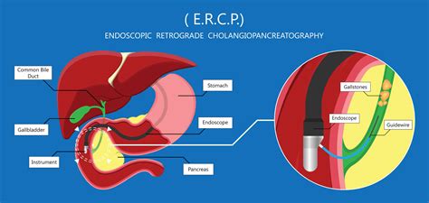 ERCP i Tyrkiet | Tjek omkostninger og priser 2025 i Tyrkiet