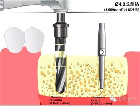 【口腔种植】韩国Dentium种植体植入外科流程|牙科种植|陕西嘉友科贸有限公司