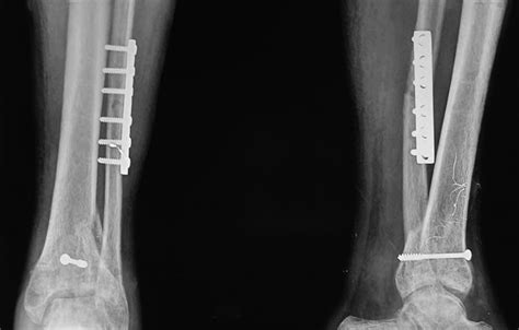 Capsuloligamentotaxis and definitive fixation by an ankle-spanning ...