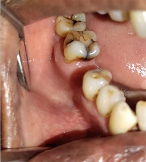 Oral lipoma: A case report with comprehensive ultrasonographic features ...