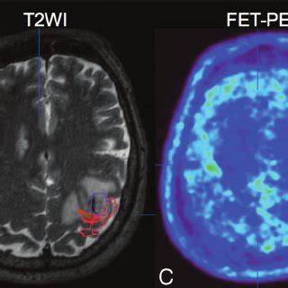 Image result for Contralateral Weakness