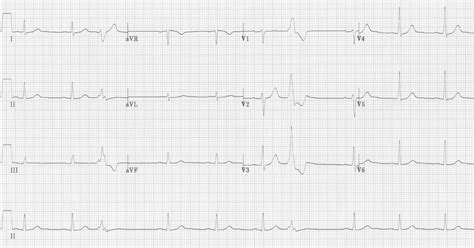 Image result for PVC ECG Reading
