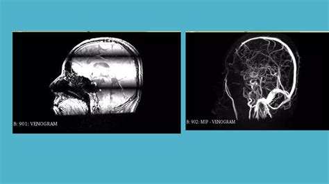 Magnetic Resonance Angiography and Venography | PPTX