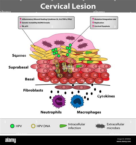 A precancerous cervical lesion. Abnormal cervical appearance. Squamous ...
