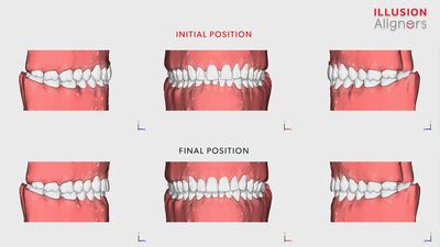 Illusion Aligners Takes the World of Orthodontics by Storm with ...
