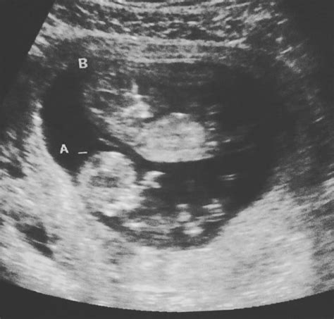 14 Weeks Ultrasound