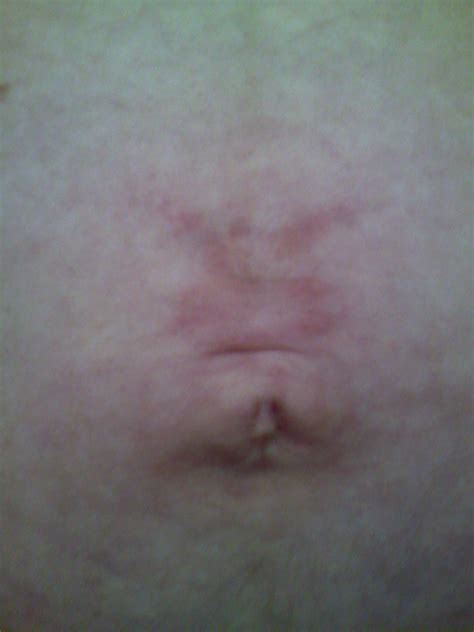 Belly Button Piercing Scar Tissue