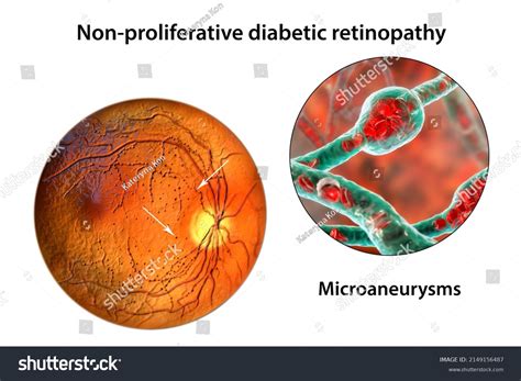 Nonproliferative Diabetic Retinopathy 3d Illustration Showing Stock ...