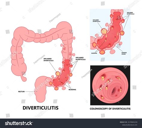 Diverticulosis Sigmoid Colon