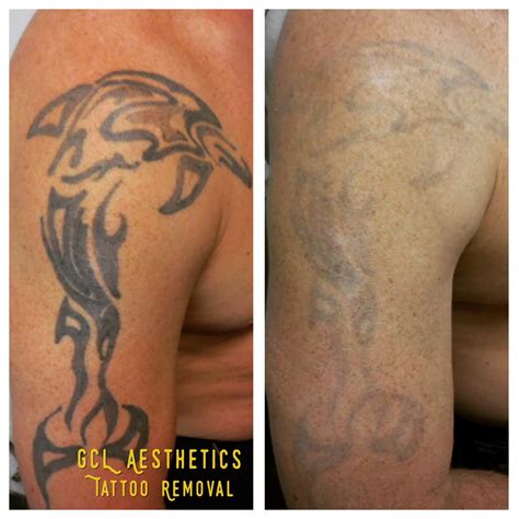 Tattoo Removal Scars