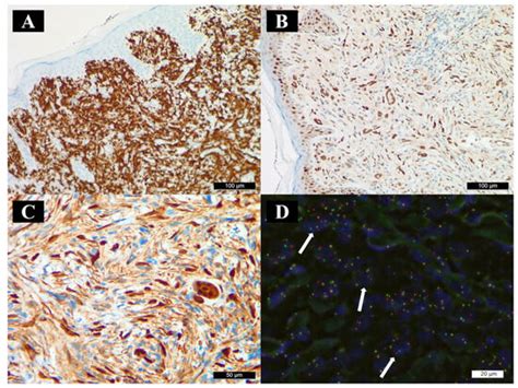 Pediatric Cutaneous Anaplastic Lymphoma Kinase-Positive Histiocytosis ...
