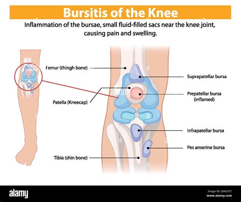 Diagram showing inflamed bursae in the knee joint Stock Vector Image ...