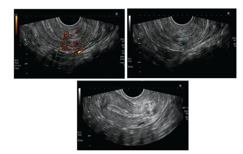 Cervical Ectopic Pregnancy