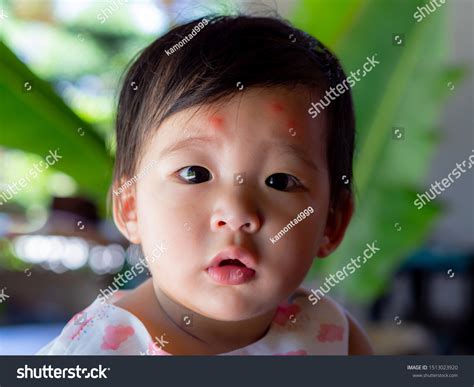 847 Asian Baby Insect Bite Images, Stock Photos & Vectors | Shutterstock