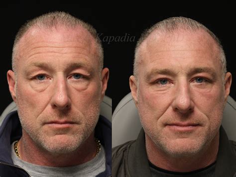 Before and 6 months after upper and lower blepharoplasty surgery with lower lid CO2 laser ...