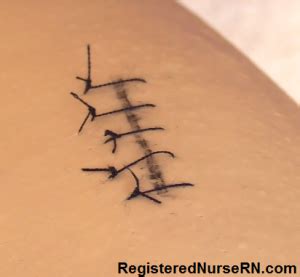 Removing Sutures Step by Step 的图像结果