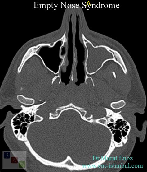 Cool, Small, Dry Turbinate: Empty Nose Syndrome
