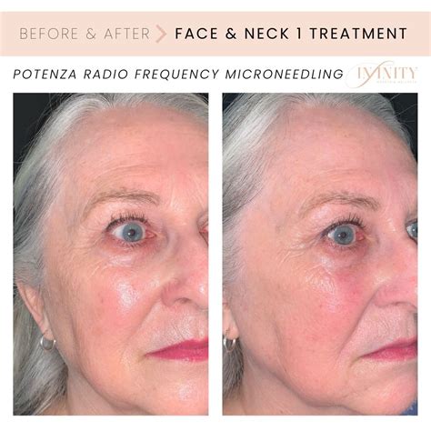RADIO FREQUENCY MICRONEEDLING — Infinity MedSpa and Wellness | Charlotte NC