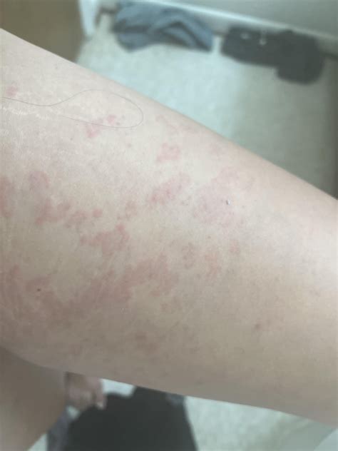 Rash on inner thighs : r/medical_advice