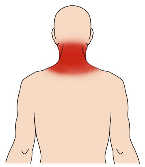 Muscle Tear In Neck