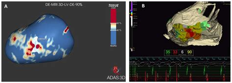 Cardiac Magnetic Resonance as Risk Stratification Tool in Non-Ischemic ...