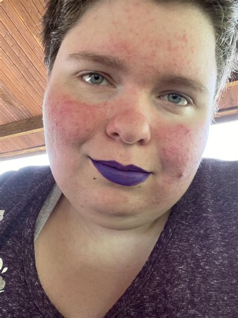 Rosacea or Undiagnosed Lupus/AutoImmune Condition? : r/skin