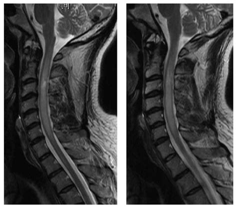 Spinal Cord Disorders | Neupsy Key