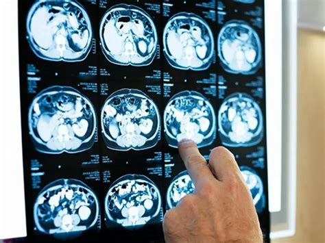 COVID-19 May Cause Brain Damage In Even Milder Cases, Claims Study