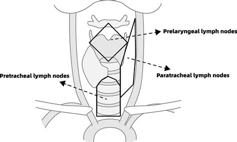 Pretracheal–laryngeal lymph nodes in frozen section predicting contralateral paratracheal lymph ...