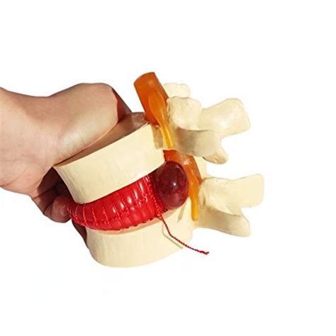 Buy w-Oral Anatomical Human Lumbar disc herniation Demonstration Model ...