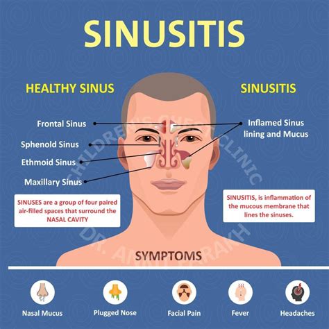 Sinusitis Kidshealth at Linda Redmon blog