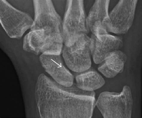 Scaphoid Wrist Fracture | Denver, Colorado — Dr. Nick Golinvaux