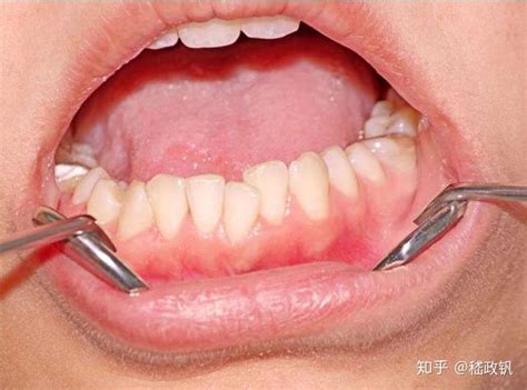 牙周炎为什么会引起牙齿脱落？牙周炎有3个特点，发现后及时治疗 - 知乎