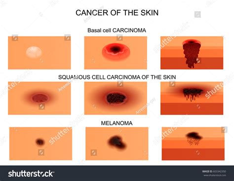 Vector Illustration Skin Cancer Initial Stage: เวกเตอร์สต็อก (ปลอดค่า ...
