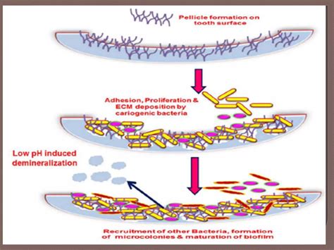 Image result for Tooth Calculus
