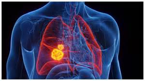 Lung Cancer Symptoms: 5 Lung Cancer symptoms that often go unnoticed ...