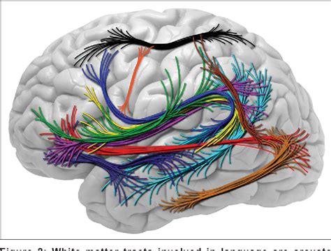 Image result for Language Mapping Awake