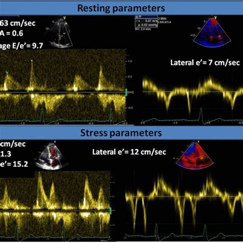Image result for Moderate Diastolic Dysfunction